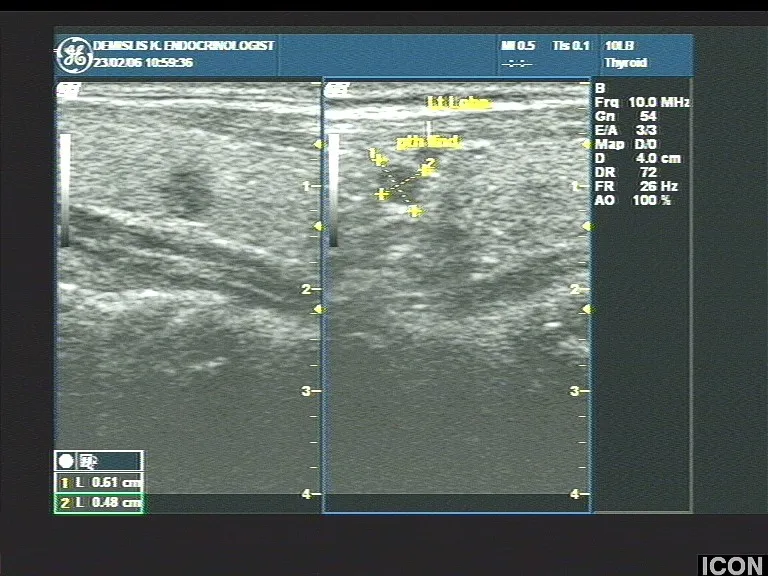 Παρακέντηση Θυρεοειδούς κατευθυνόμενη με υπέρηχο